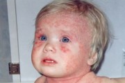 Аллергический дерматит у детей, симптомы и лечение